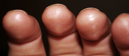 healthy guitar calluses